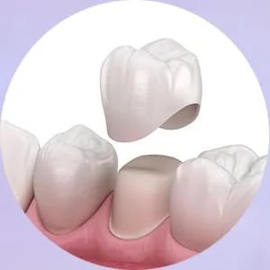 керамическая вкладка на зуб